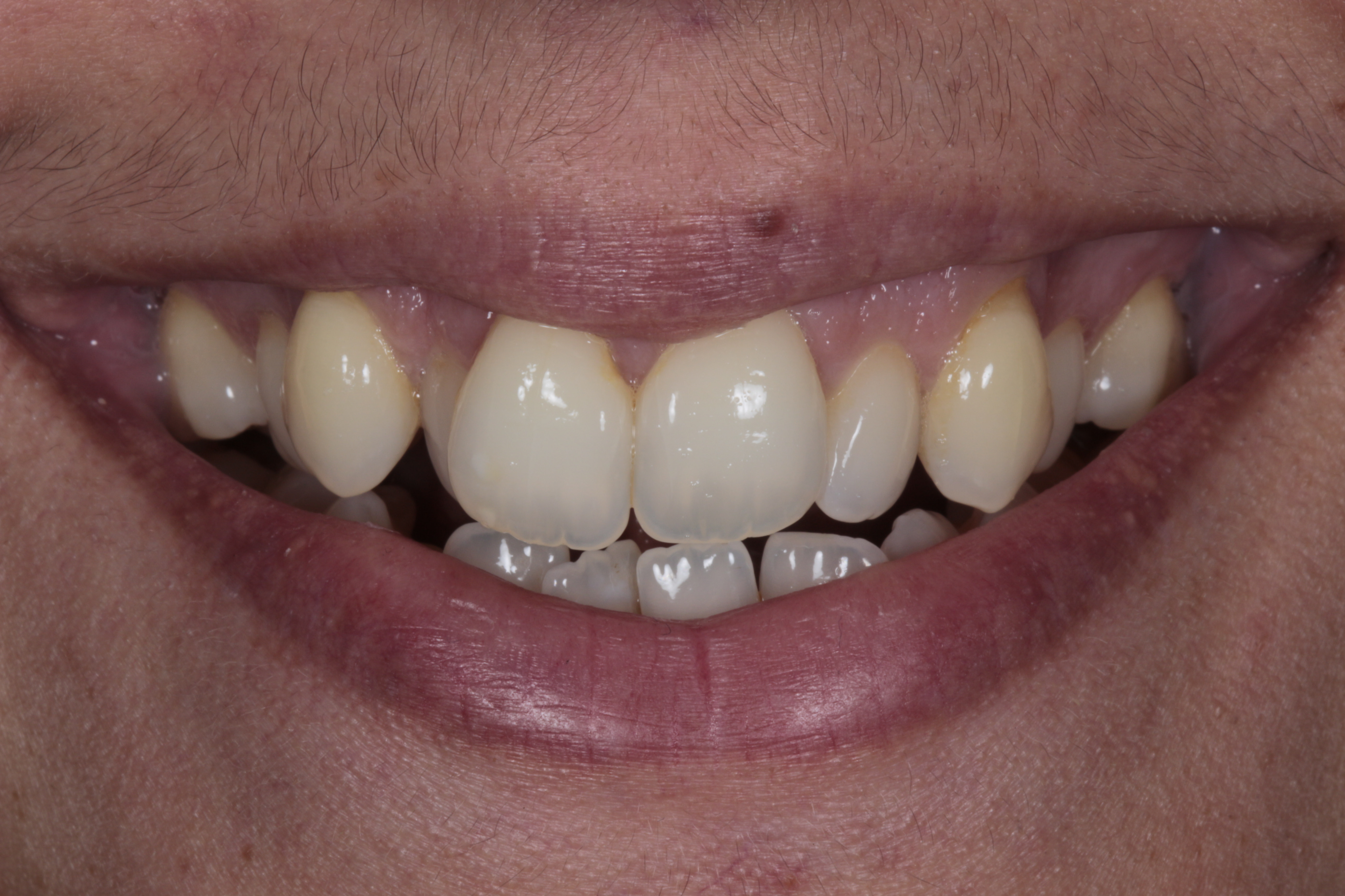Patient 2 smile before treatment