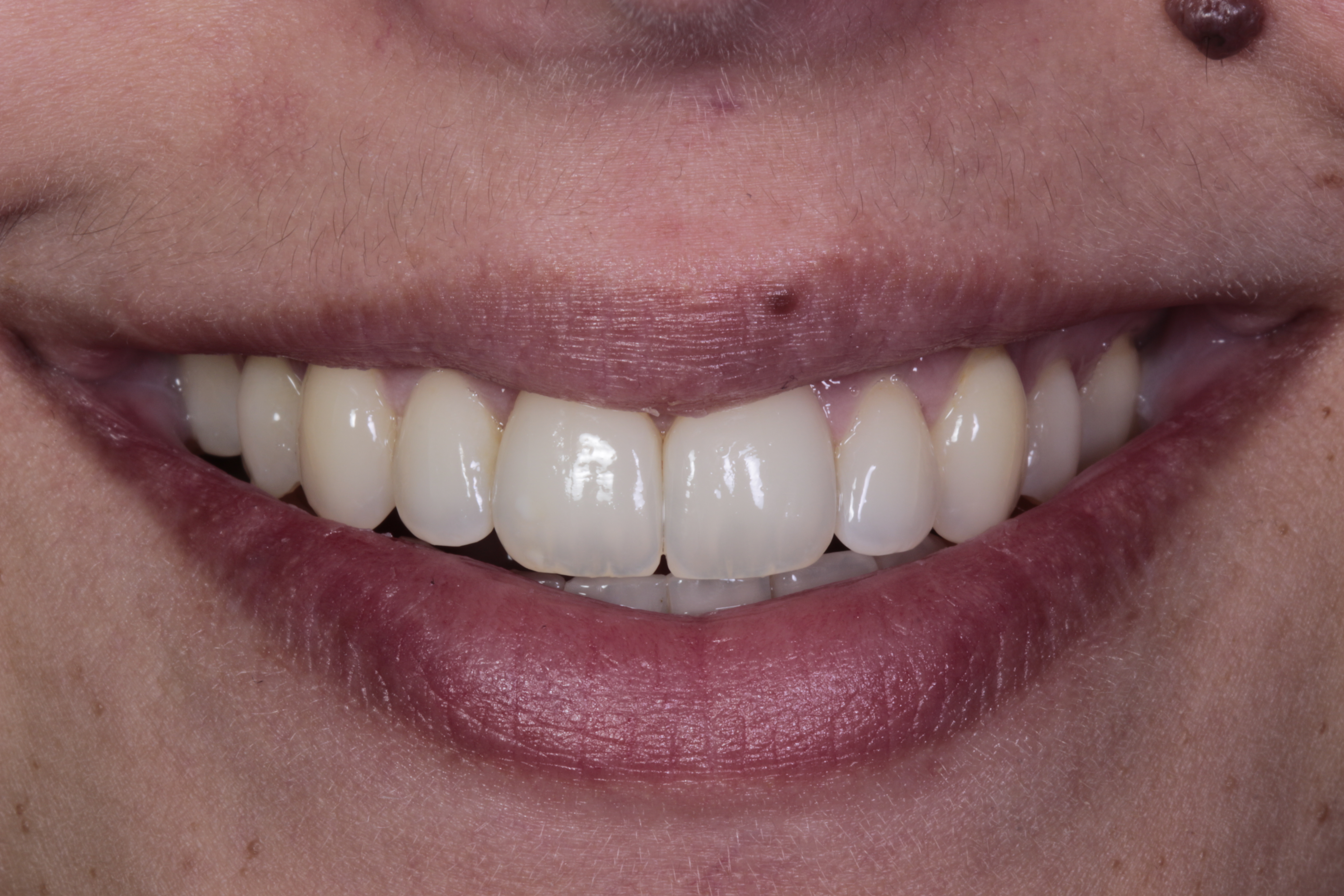 Patient 2 smile after Invisalign and teeth whitening
