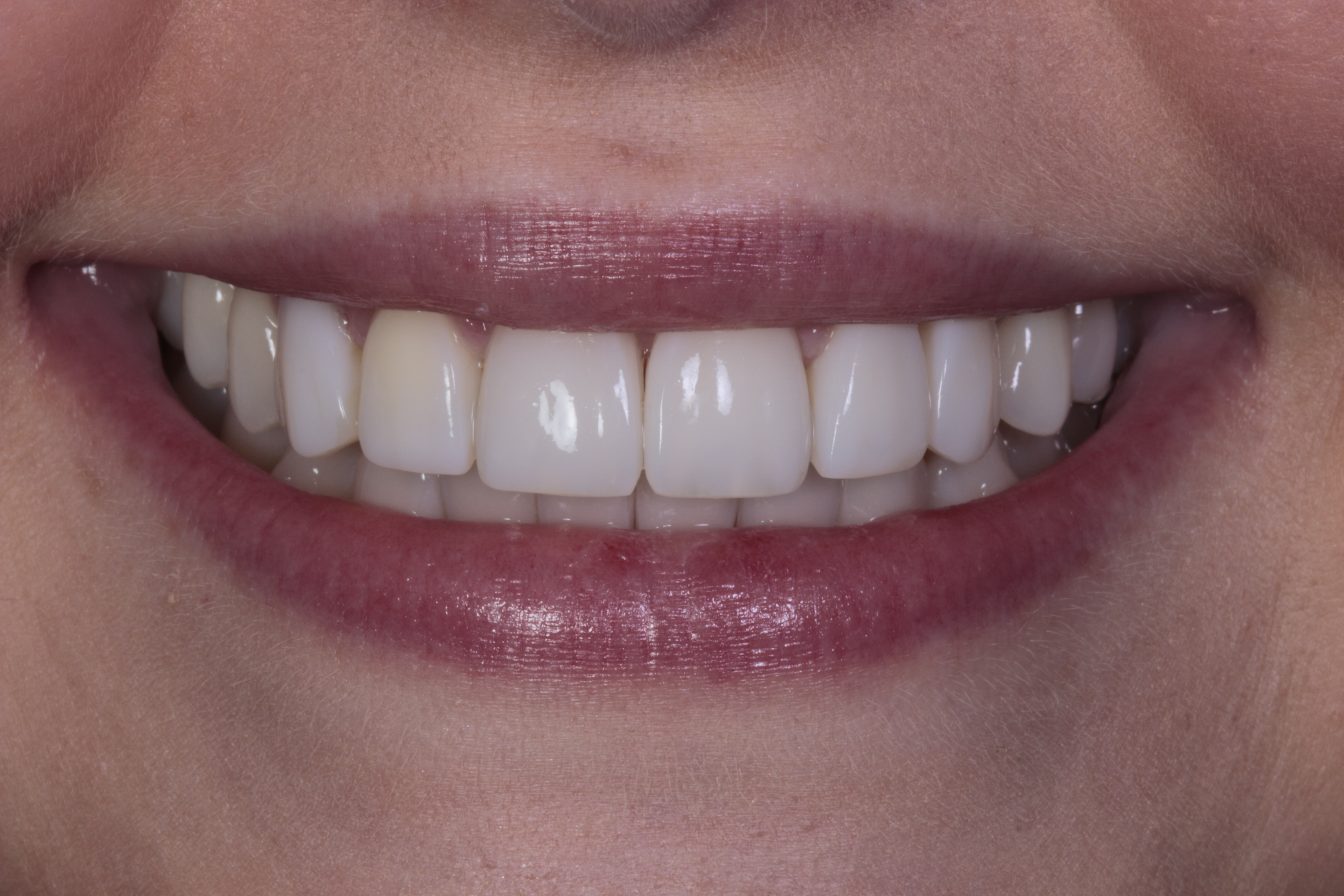Patient 1 smile after Invisalign, teeth whitening and composite bonding