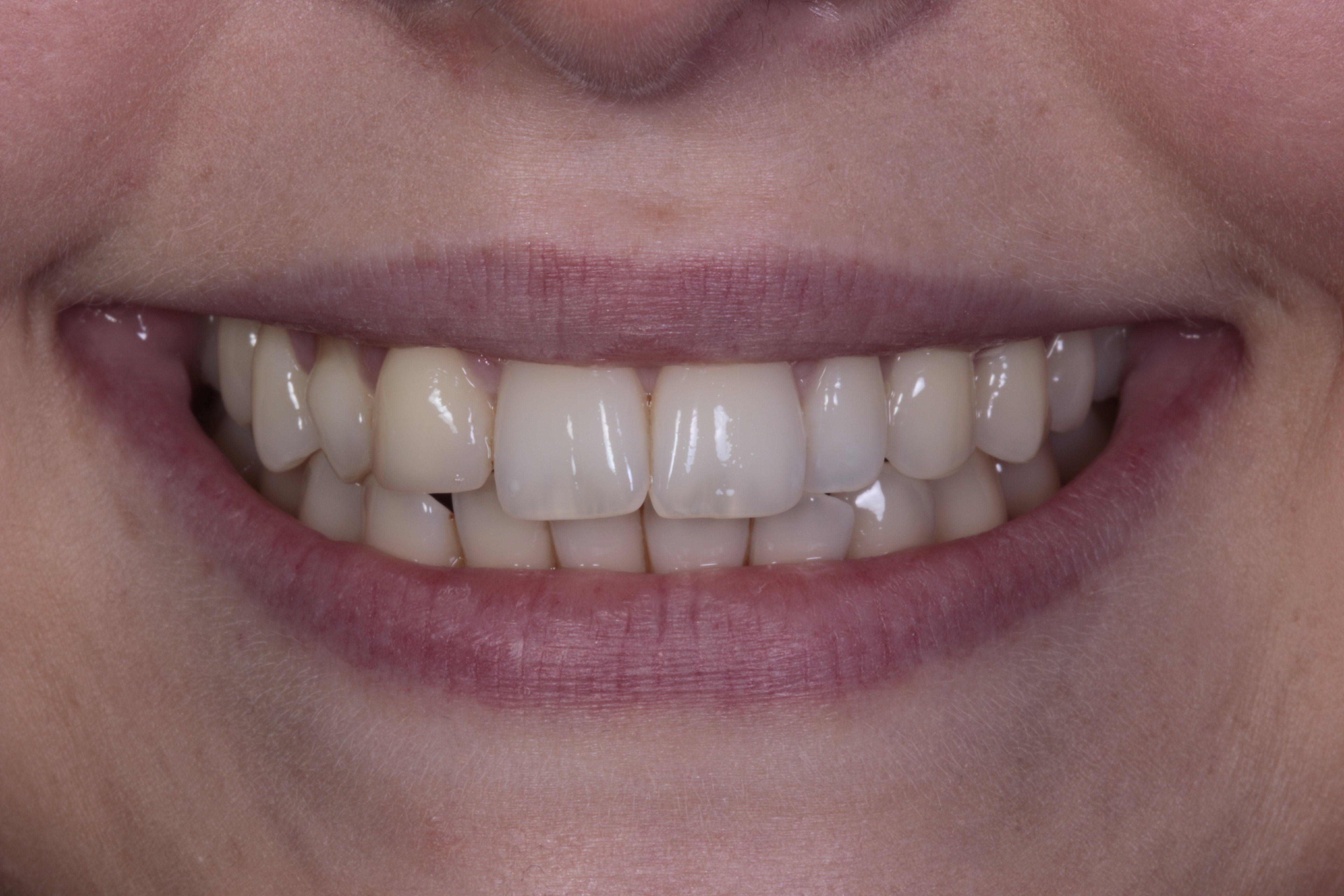 Patient 1 smile before treatment