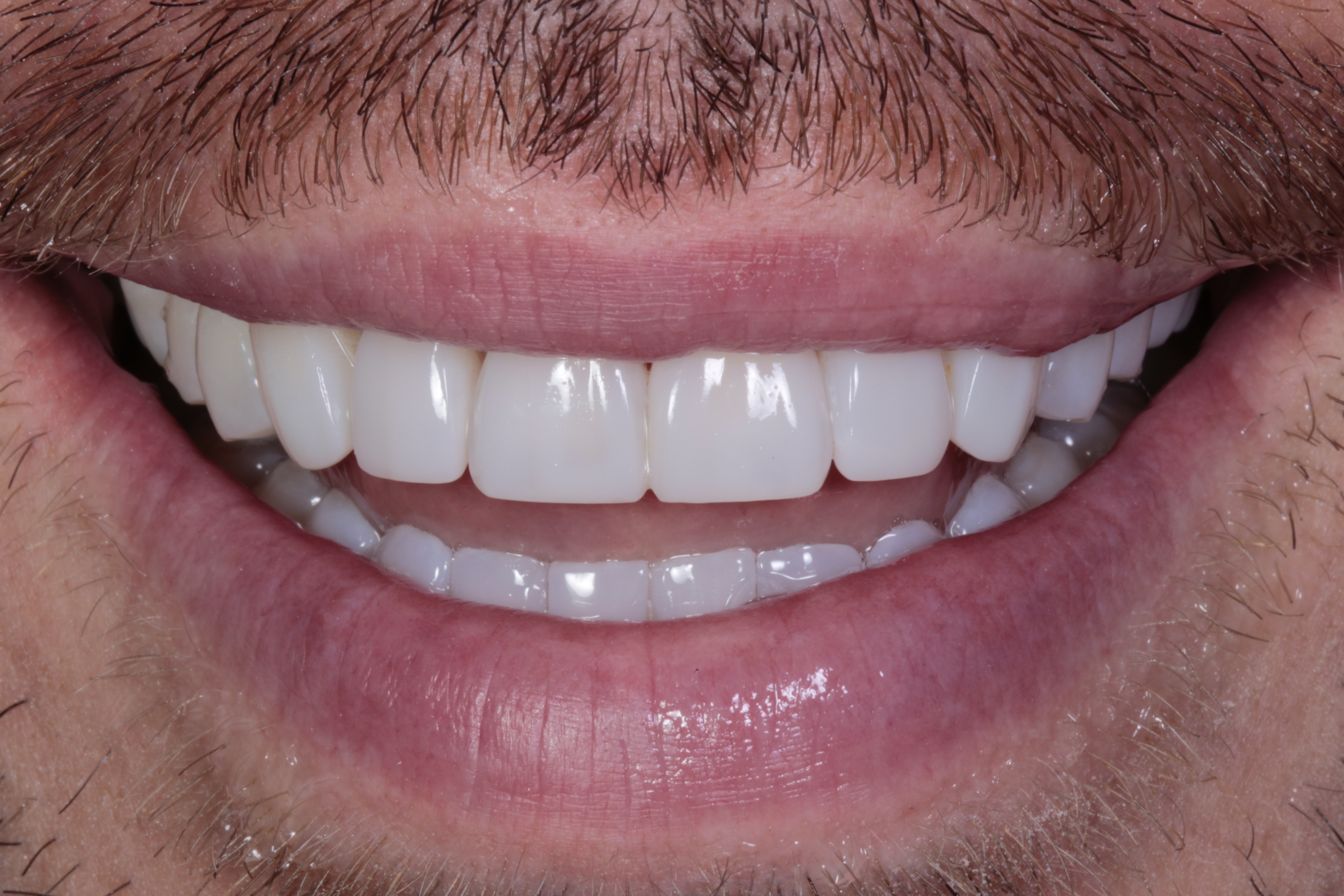 Patient 3 smile after Invisalign, teeth whitening and composite bonding