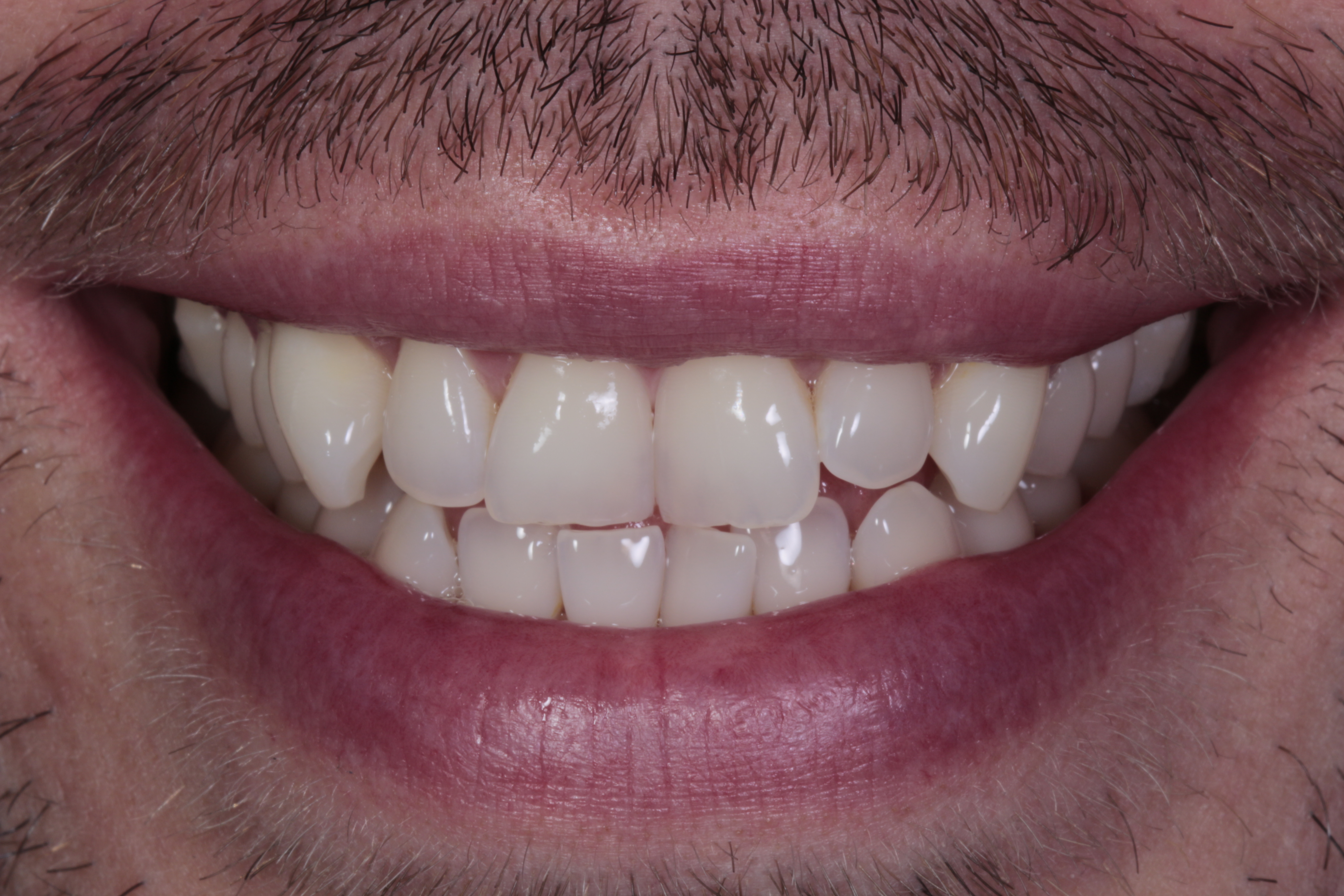 Patient 3 smile before treatment